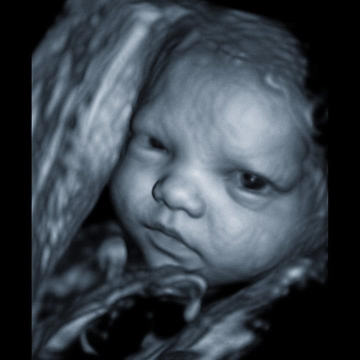 4D ultrasound still - face