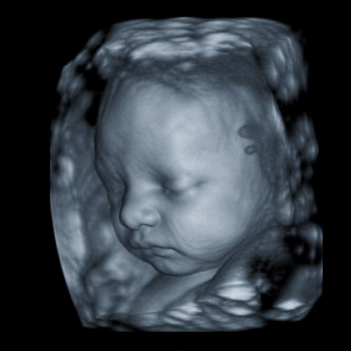 4D ultrasound still - three-quarter