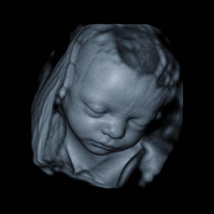 4D ultrasound still - tilted face
